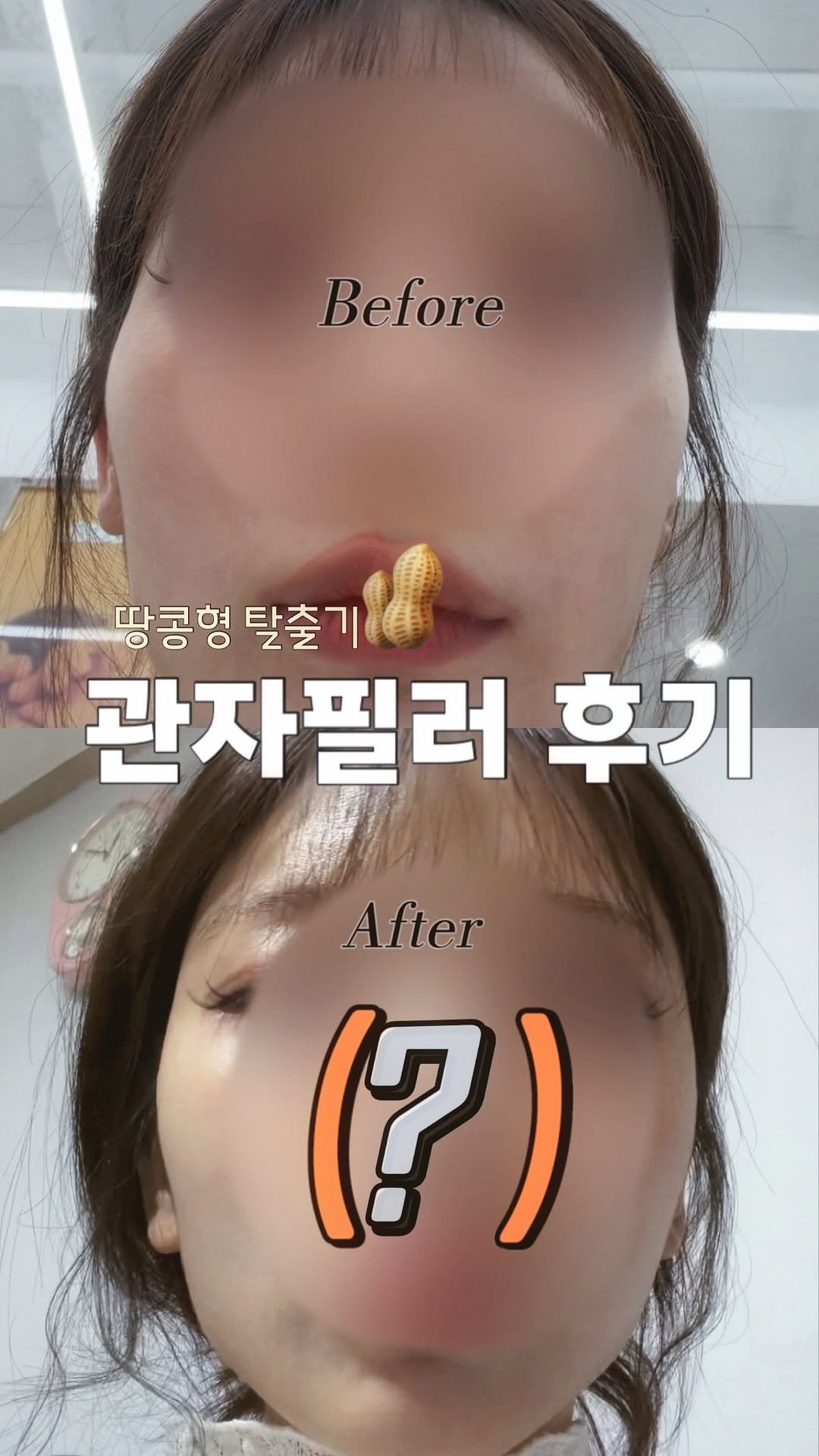 s2weetme 게시물 이미지: 저 땅콩형 얼굴 탈출했어요 🙋‍♀️🥜✨

나이 들수록 얼굴살은 빠지고 광대가...