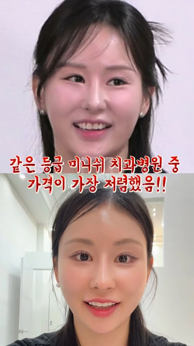 seo_youl__ 게시물 이미지: 어릴 때 했던 교정치아… 관리가 제대로 안 돼서 
치아가 다시 삐뚤어지고 벌어지면서...