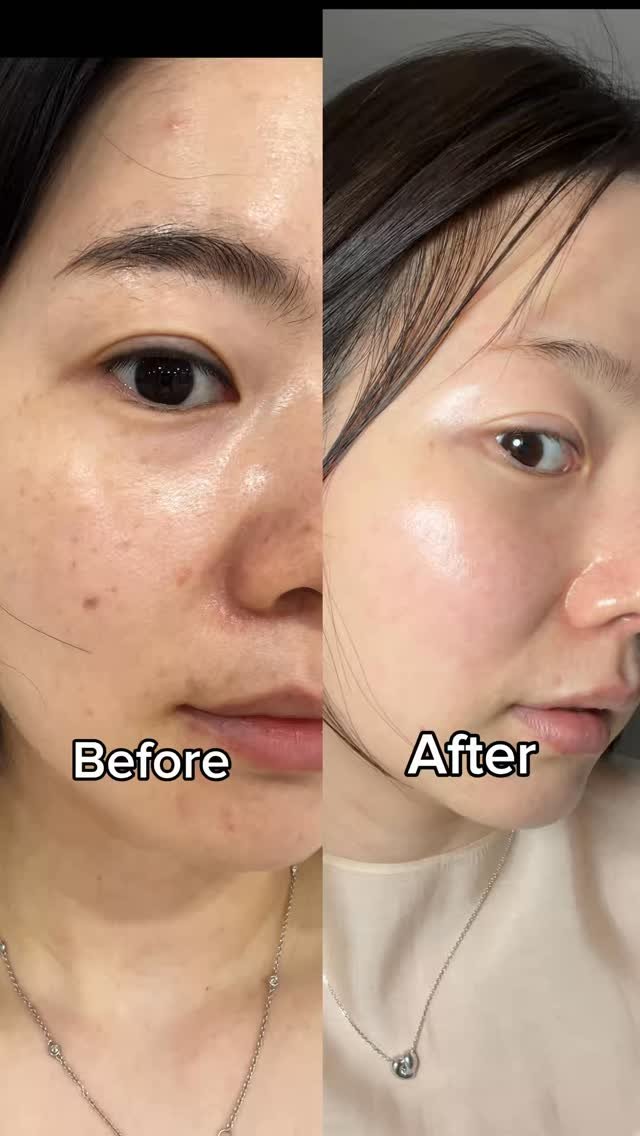 shany__day_ 게시물 이미지: #내일마감 기미는 레이저만 답인 줄 알았던 나 🙋🏻‍♀️

기미 고민하고 슬퍼하고만...