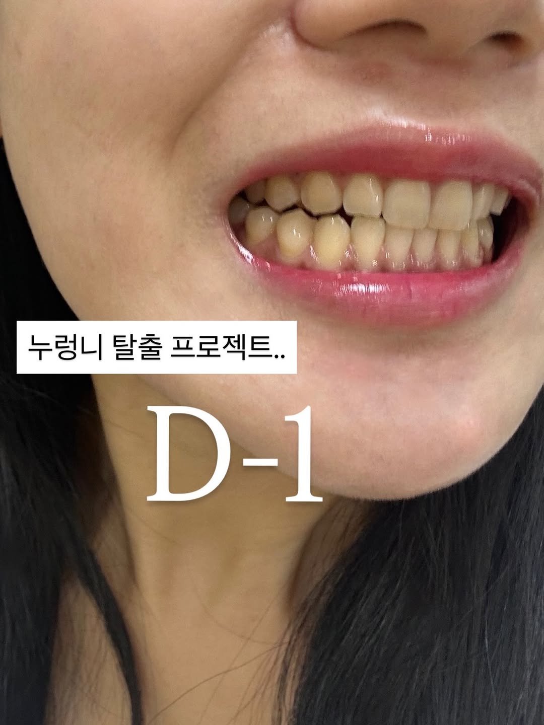 sharon_0817_ 게시물 이미지: #D-1 #화이트랩스
식사하시는분들..야식 드시는 분들 죄송…☹️

진심 치아에...