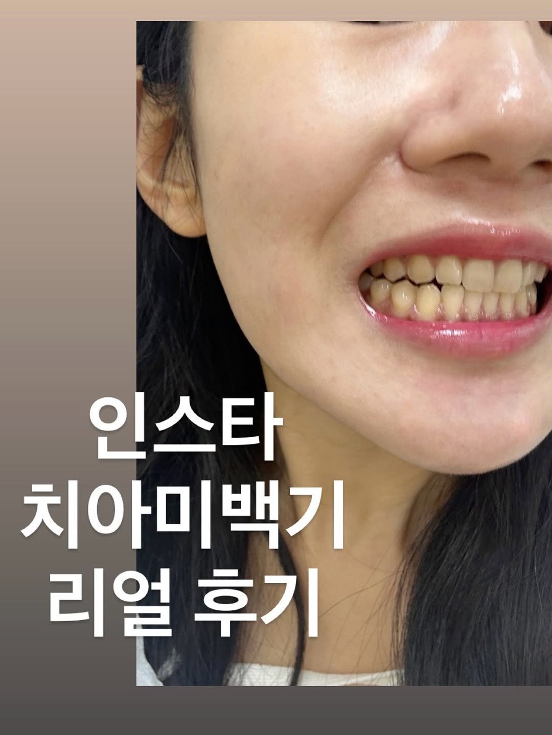 sharon_0817_ 게시물 이미지: 눈갱 죄송합니다.. 🙄🤧
식사하시던분들은 살포시 뒤로가기를… 
저도 동생치아 이렇게...