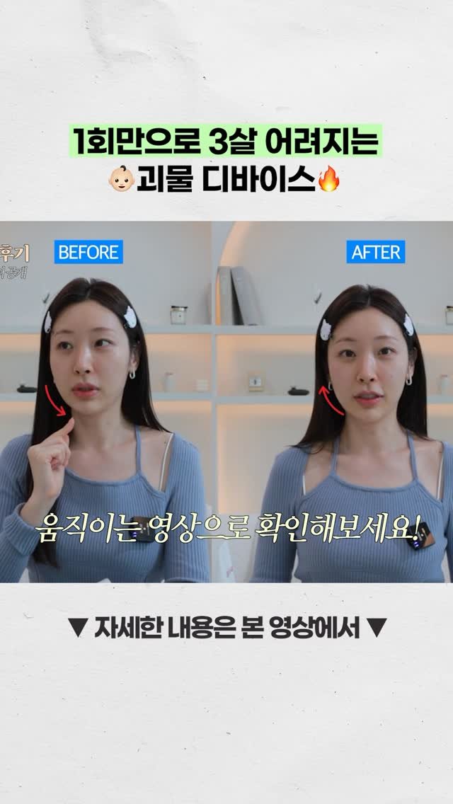 simtohl 게시물 이미지: 오이상 롱안부 -1cm 축소 구원🙏🏻 중안부 시술 디바이스 실큰 56% 런칭...