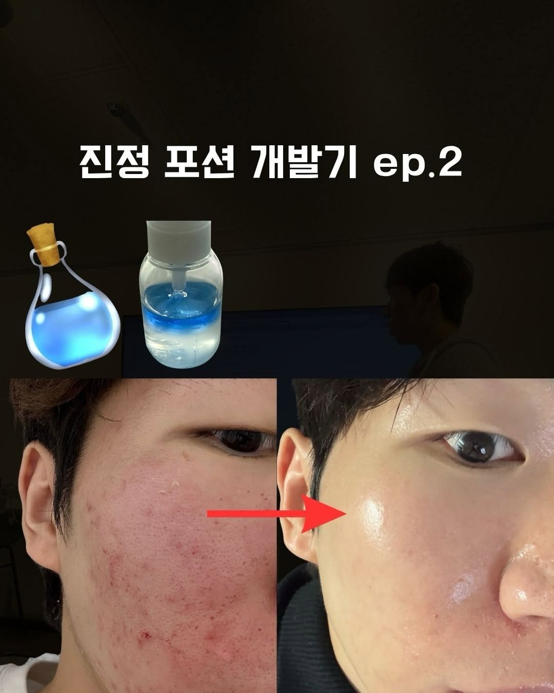 skin_mst 게시물 이미지: 이제 곧!! 체험단을 통해 실제 여드름을 겪고 있는 분들의 
피드백을 듣게 될 것...