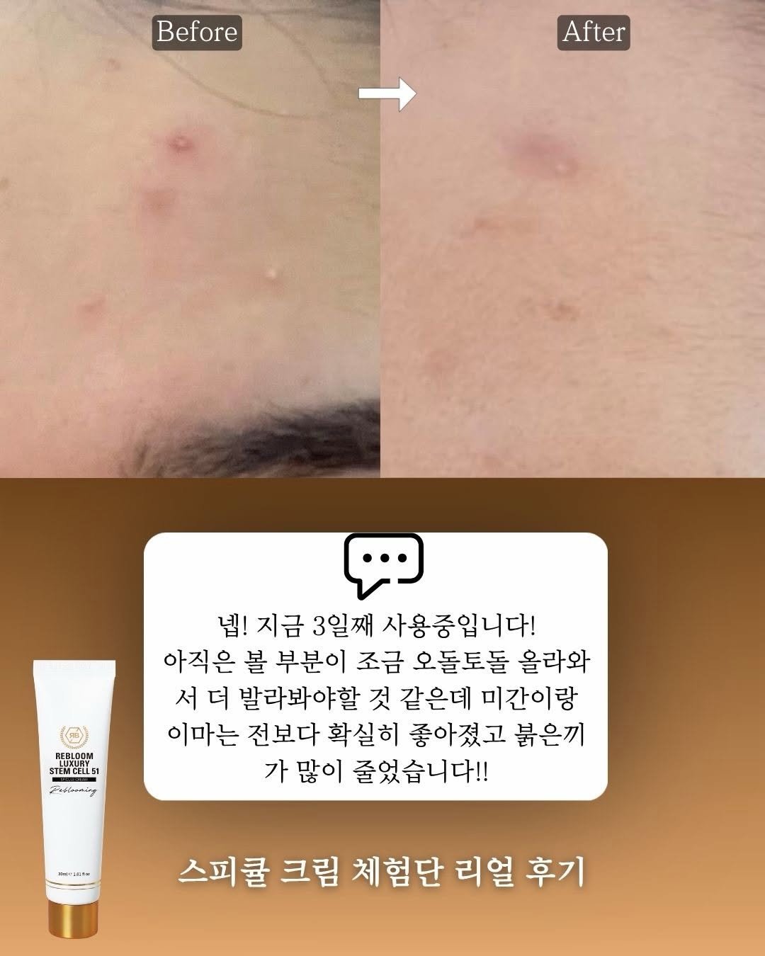 skin_mst 게시물 이미지: 스피큘 너무 좋아 ㅠㅠㅠㅠ 
다들 짧게는 2일, 많게는 5일 정도 
사용해보고...
