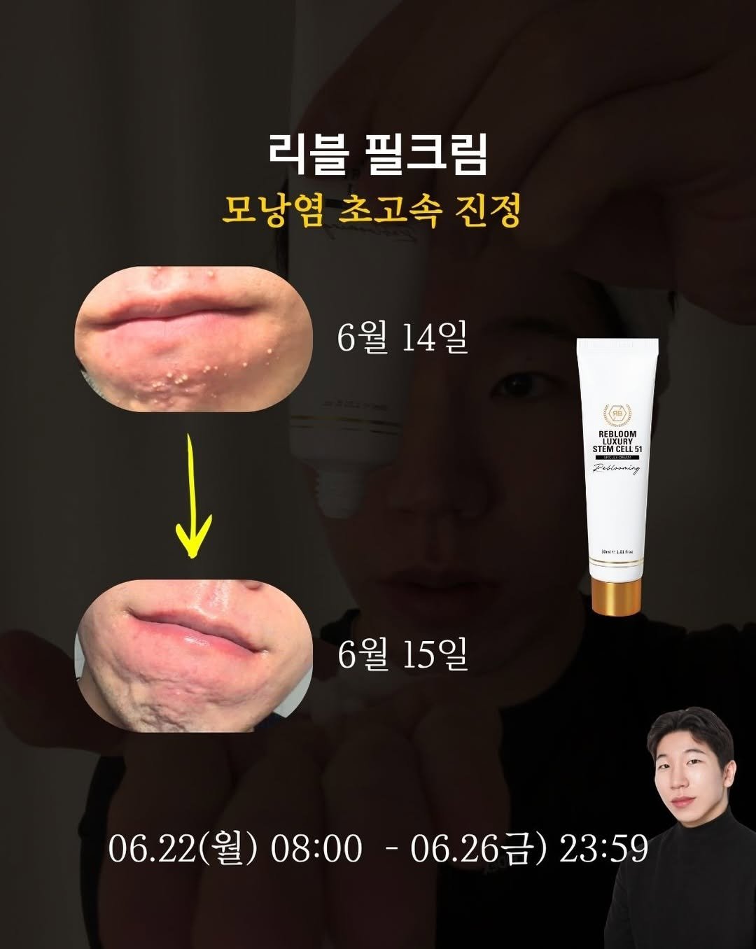 skin_mst 게시물 이미지: 여러분.. 🥹 모낭염 초고속 진정 스피큘 크림
마켓으로 가져오게 되었어요!!...