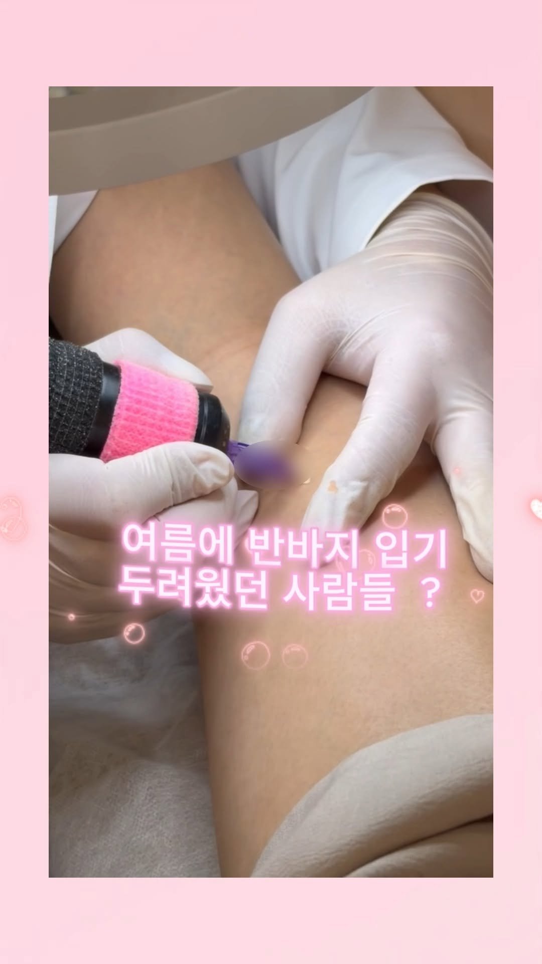 skinbeauty__101 게시물 이미지: 출산, 다이어트, 키성장으로 생긴 튼살 때문에 반바지 입기 두려우셨다고요...