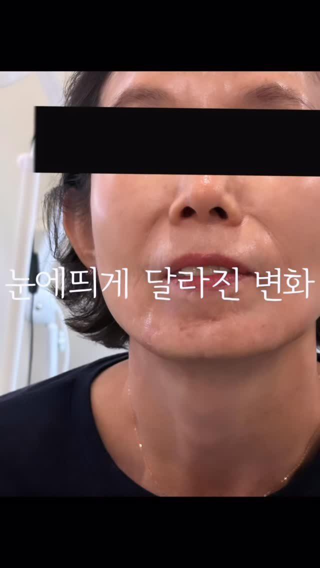 skinbeauty__101 게시물 이미지: 턱 백반증 때문에 신경 쓰이셨나요?

단순히 색만 맞추는 게 아니라
주변 피부톤과...