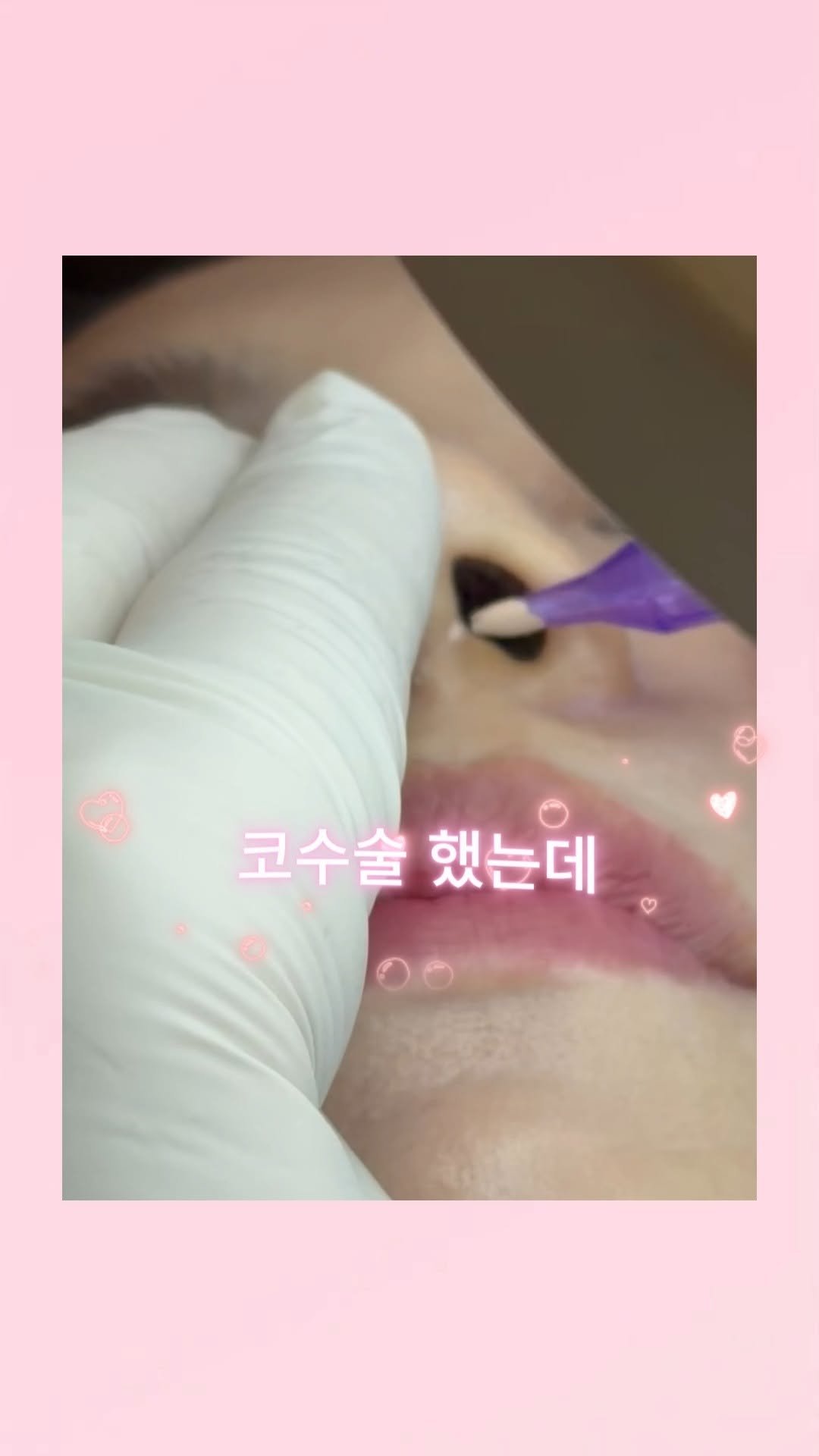 skinbeauty__101 게시물 이미지: 코 흉터 때문에 계속 신경 쓰이셨던 분들
가릴수록 더 눈에 띄는 느낌이라 고민...