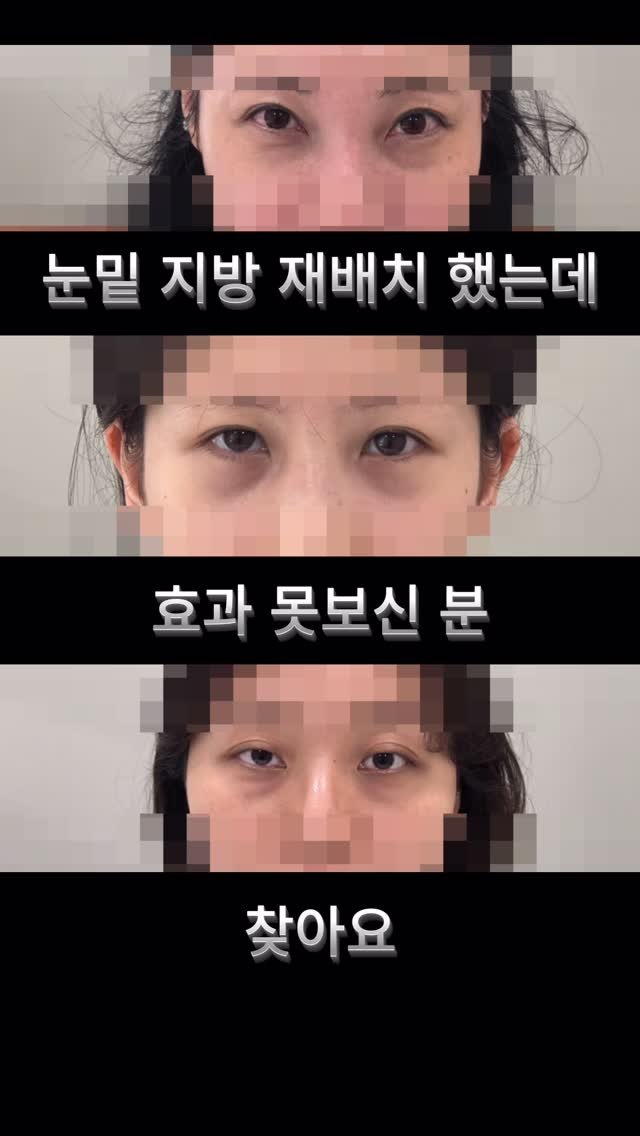 skinbeauty__101 게시물 이미지: ⚠️ 다크써클 10년유지⭕️ 보신 적 있으신가요?

스킨뷰티는 다릅니다.✨

✔️...