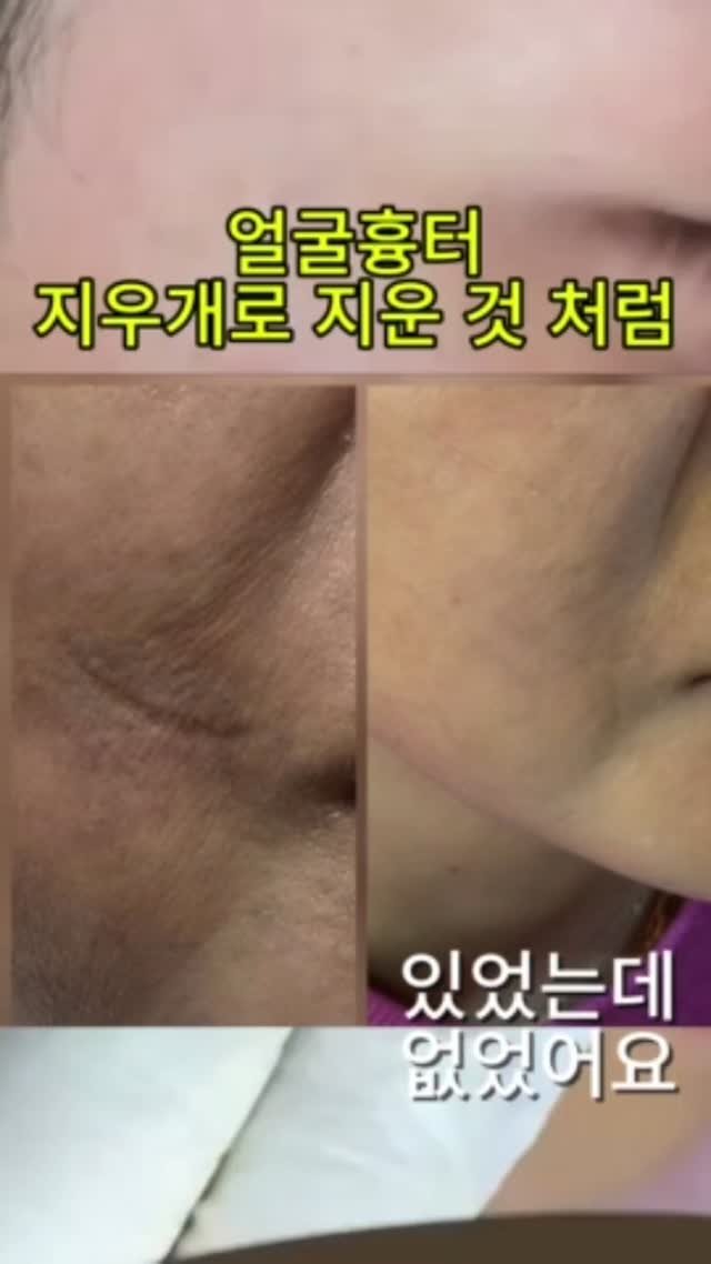 skinbeauty__101 게시물 이미지: 포토샵 아니고 스킨타투 👋

흉터 고민은 스킨 타투로 싹 해결!

깜짝 놀랄 만큼...