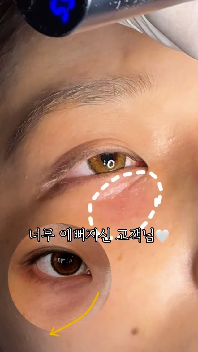 skinbeauty__101 게시물 이미지: 오늘도 예뻐지신 고객님 이야기.

눈밑 색소침착과 경계 때문에 
늘 피곤해 보인다는...