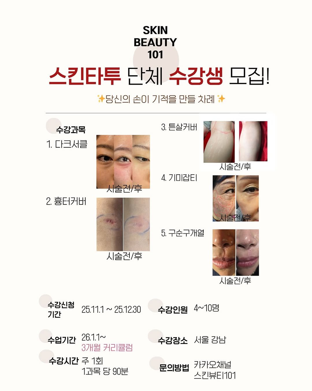 Photo by 기미 기미크림 기미제거 다크서클관리 기미관리 기미제거 다크서클 다크서클커버 다크서클제거 다크서클반영구 눈밑지방재배치 on October 31, 2025. May be an image of text that says 'SKIN BEAUTY 101 스킨타투 단체 수강생 모집! 당신의 손이 기적을 만들 차례 수강과목 1.다크서클 3.튼살커버 3. 4. 4.기미잡티 시술전/후 人生色 2 흉터커버 시술전/후 5. 구순구개열 시술전/후 460 시술전/후 수강신청 기간 25.11.1~ 25.11.1~25.12.30 25.12.30 수강인원 4~10명 수업기간 26.1.1~ 3개월 커리큘럼 수강시간 주 1회 1과목 1과목당90분 당 90분 수강장소 서울강남 서울 강남 문의방법 카카오채널 스킨뷰티101'.