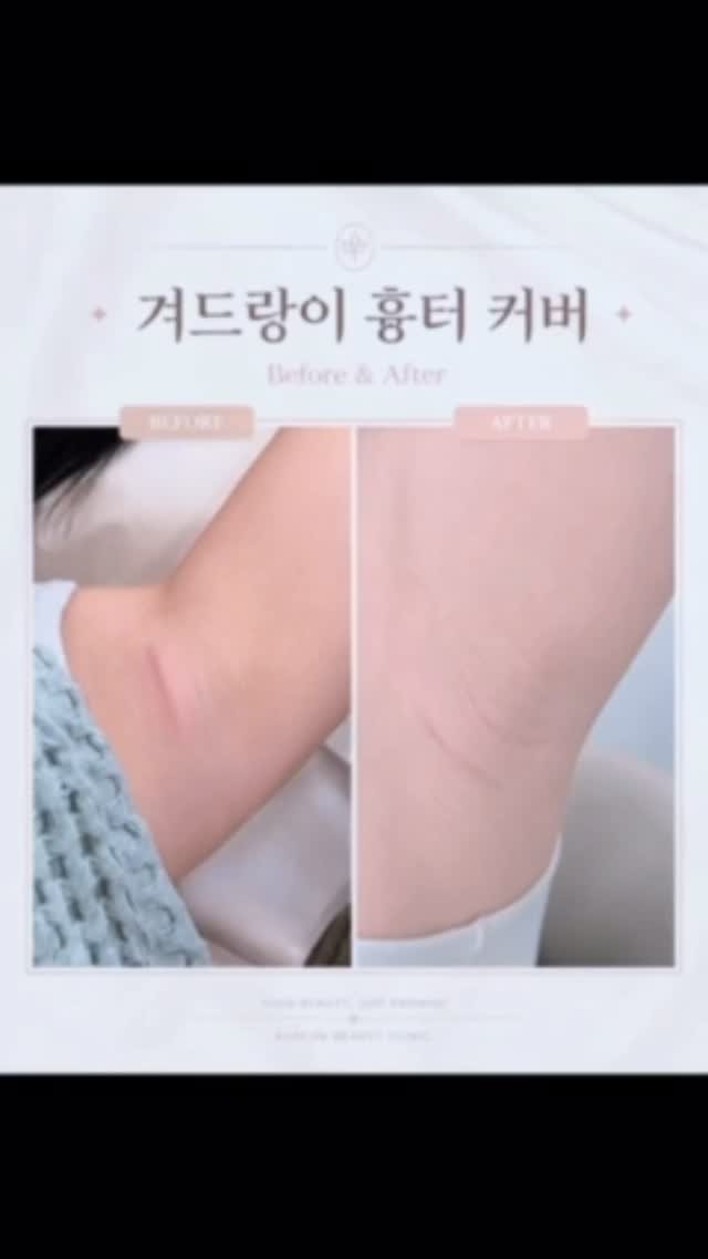 skinbeauty__101 게시물 이미지: ”이 흉터도 커버될까요?“

최근 DM 문의 중 가장 많은 문의가
바로 겨드랑이...