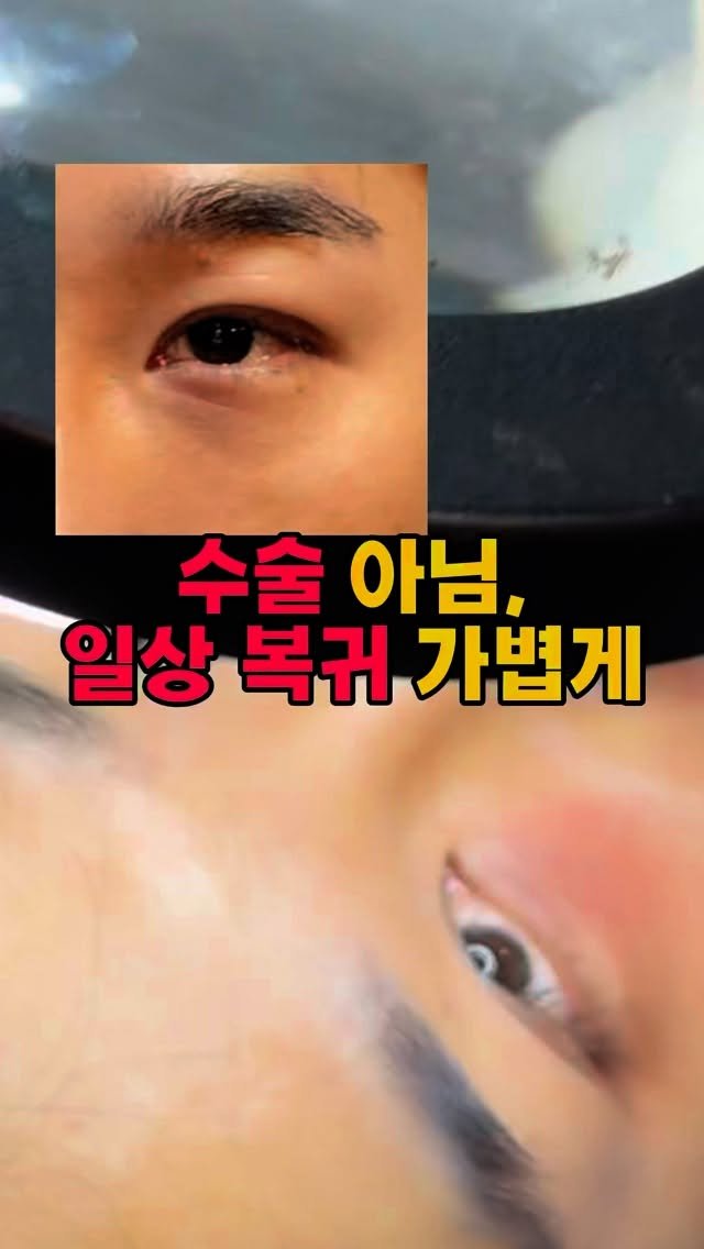 skinbeauty__101 게시물 이미지: 👀 수술 없이도 가능하다면 믿으시겠어요?
눈밑 꺼짐, 다크서클 때문에 늘 피곤해...