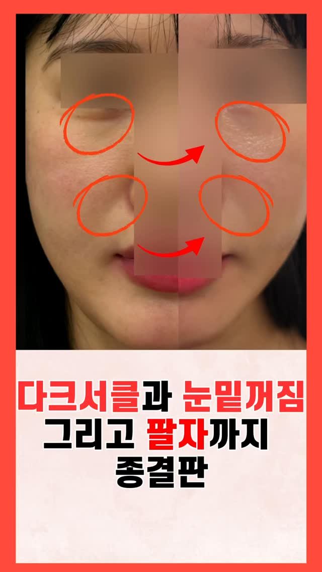 skinbeauty__101 게시물 이미지: 다크서클·눈밑꺼짐·팔자, 한 번에 정돈해 보이게

표피 0.04mm...