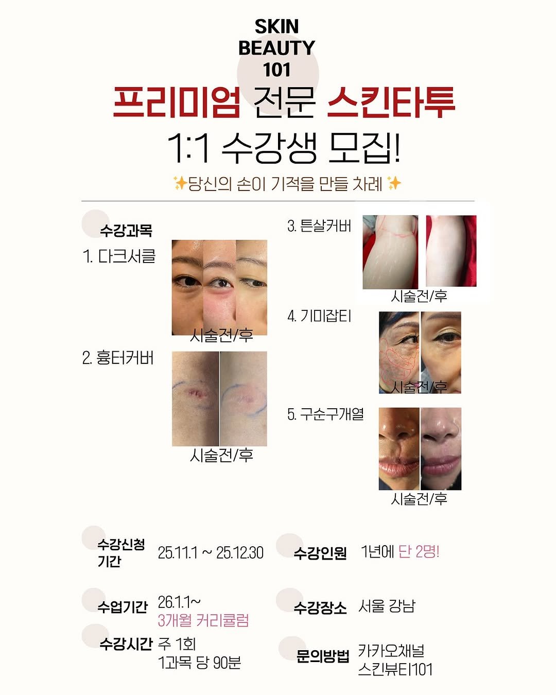 Photo by 기미 기미크림 기미제거 다크서클관리 기미관리 기미제거 다크서클 다크서클커버 다크서클제거 다크서클반영구 눈밑지방재배치 on October 31, 2025. May be an image of text that says 'SKIN BEAUTY 101 프리미엄 전문 스킨타투 1:1 수강생 모집! 당신의 손이 기적을 만들 차례 수강과목 1.다크서클 3. 튼살커버 4. 4.기미잡티 시술전/후 人臣色 2 흉터커버 시술전/후 5. 구순구개열 시술전/후 Mht 시술전/후 수강신청 25.11.1~25.12.30 25.12.30 기간 25.11.1 수강인원 1년에 단 1년에단2명! 2명! 수업기간 26.1.1~ 3개월 커리큘럼 수강시간 주 1회 1과목 당 90분 수강장소 서울 서울강남 강남 문의방법 카카오채널 스킨뷰티1101'.