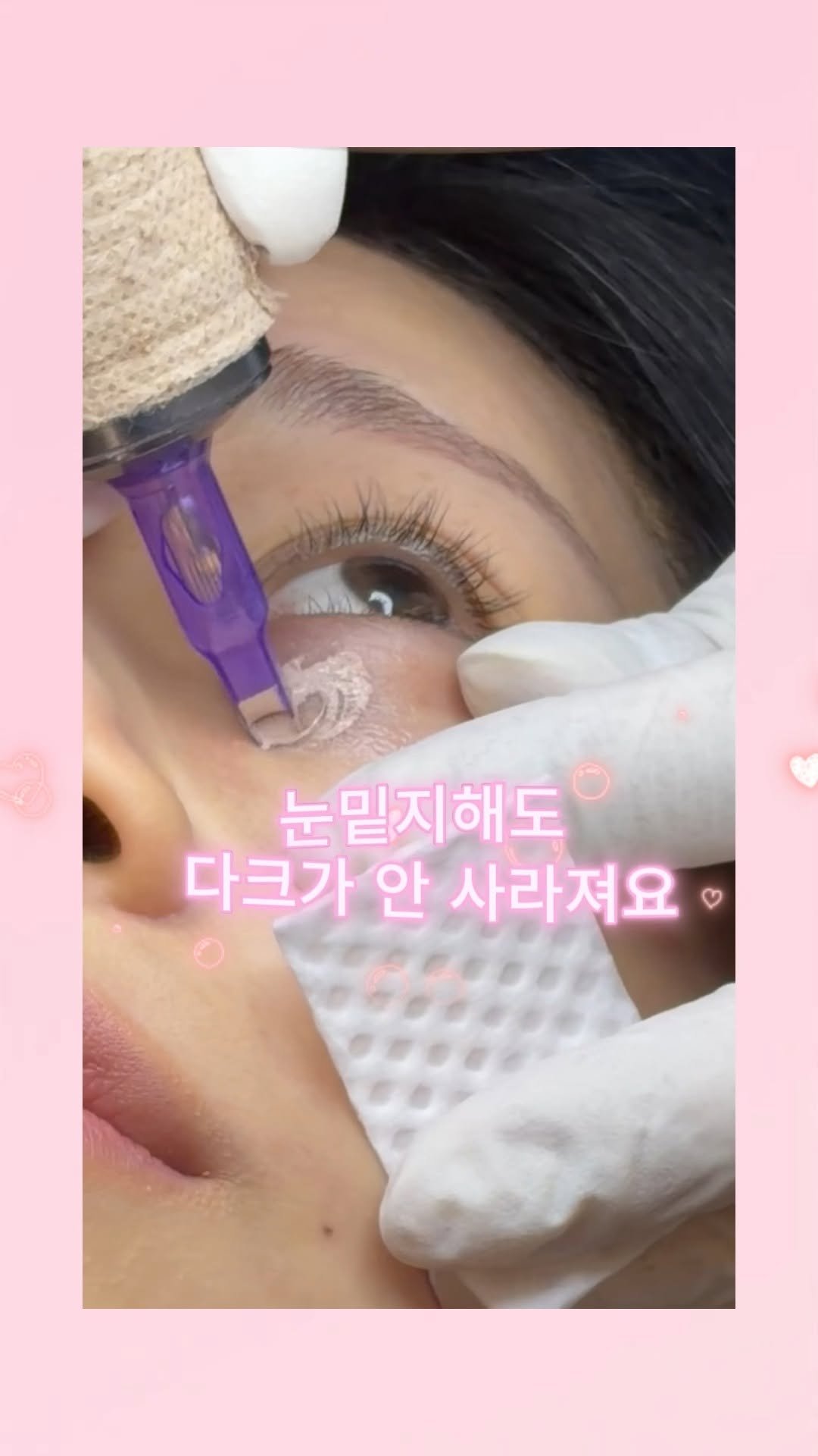 skinbeauty__101 게시물 이미지: 눈밑지해도 다크가 안 사라져요 ... 피부톤 때문일 수도 있어요 ! 

눈밑 지방...