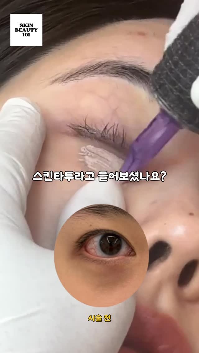 skinbeauty__101 게시물 이미지: “스킨타투요? 처음 들어보셨죠?”
눈밑 다크서클, 색소침착, 꺼짐 때문에 얼굴이...