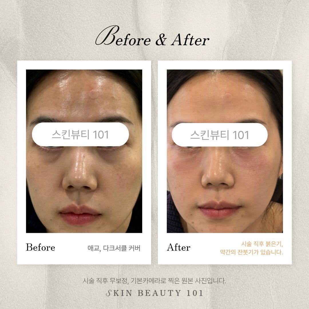 skinbeauty__101 게시물 이미지: 🏆스킨뷰티101 강남본점 / 대구

📍강남 최다 임상 시술
📍누적시술 50,000건...