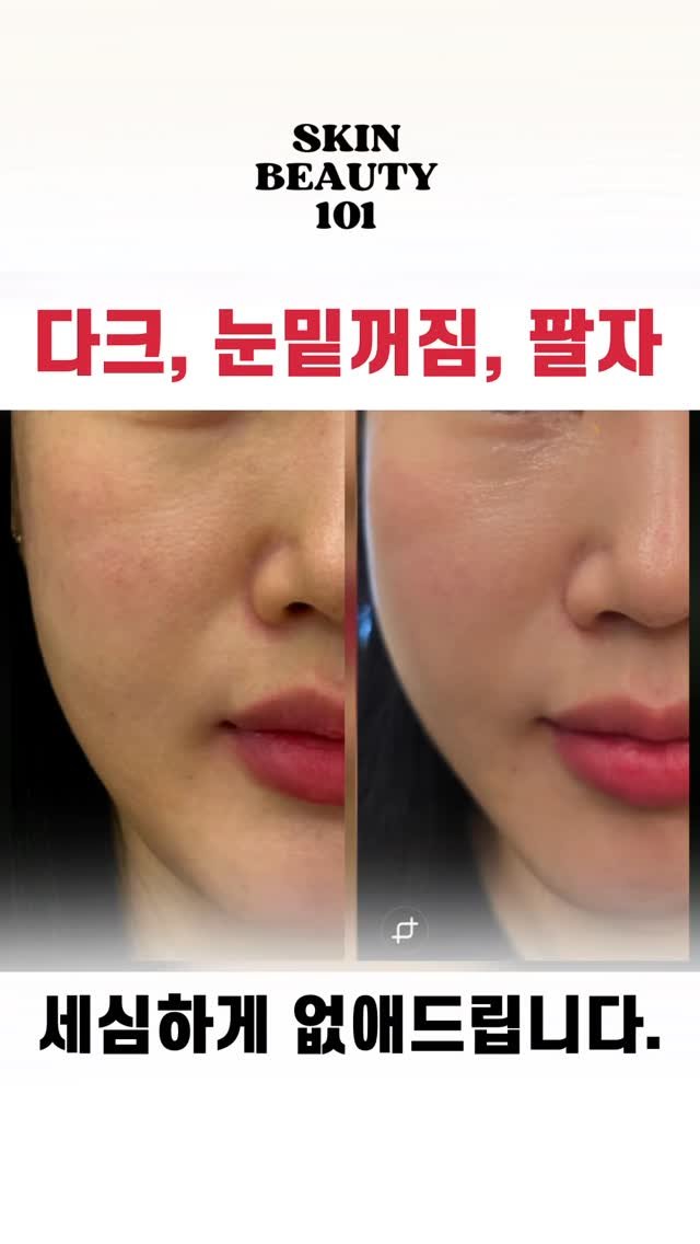 skinbeauty__101 게시물 이미지: 전체적으로 다크 꺼짐 리프팅 라인 시술 
이뻐지고 어려지고

#기미제거 #기미타투...