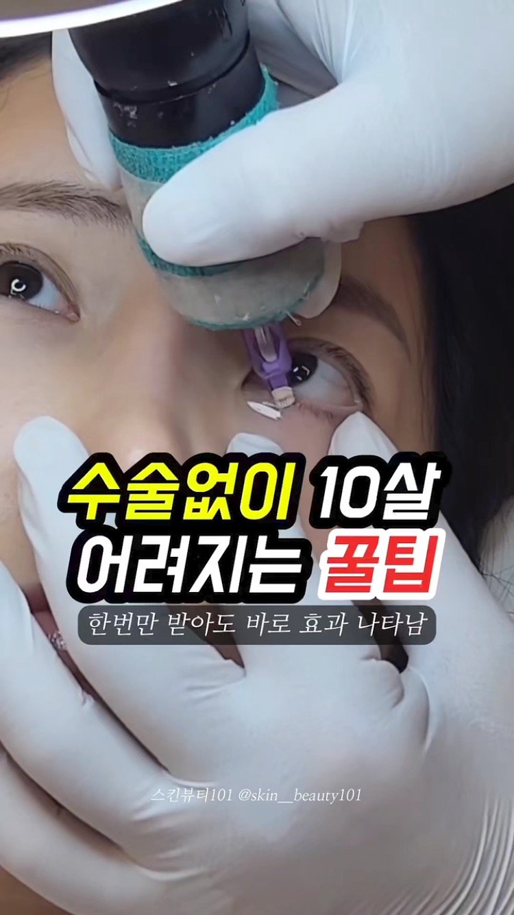 skinbeauty__101 게시물 이미지: 📢 수술 없이 어려지는 꿀팁! 다크서클 고민 해결법 공개 ✨

혹시 거울 볼 때마다...