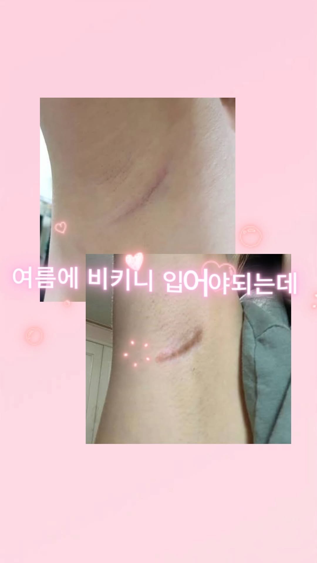 skinbeauty__101 게시물 이미지: 여름철 겨드랑이 흉터 ... 지긋지긋하시죠 ?

민소매를 입을 때,
수영복을 입을...
