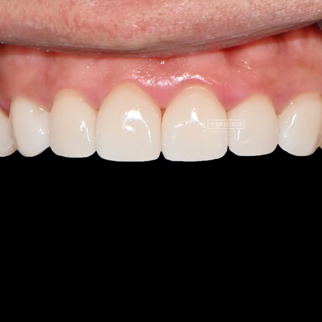Photo shared by 스탠다드치과 심미치료 on January 09, 2025 tagging @standard__dental, @std2000dental, and @standard__bucheon.
