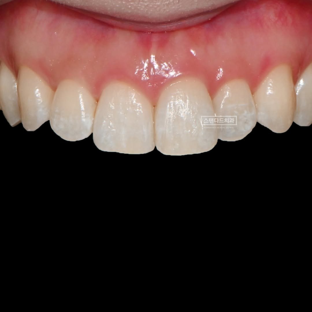 Photo shared by 스탠다드치과 심미치료 on January 09, 2025 tagging @standard__dental, @std2000dental, and @standard__bucheon.