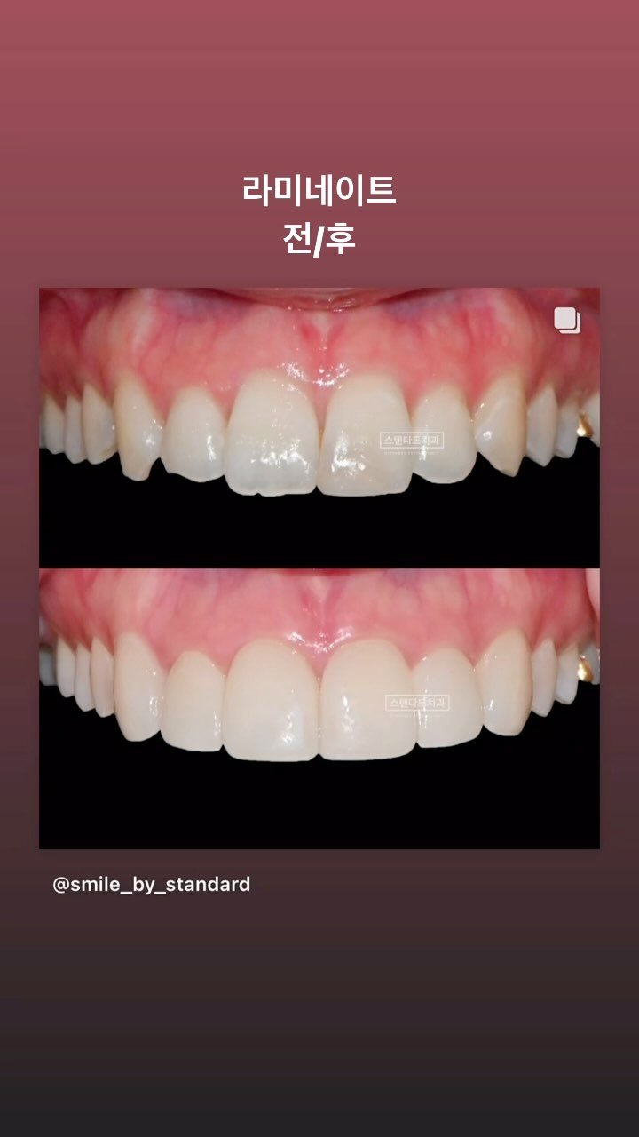 smile_by_standard 게시물 이미지: 당신의 자신감을 한층 더 빛나게 해줄 스탠다드 치과 라미네이트

➰개인별 맞춤으로...