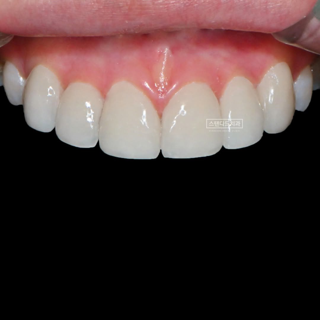 Photo shared by 스탠다드치과 심미치료 on January 09, 2025 tagging @standard__dental, @std2000dental, and @standard__bucheon.