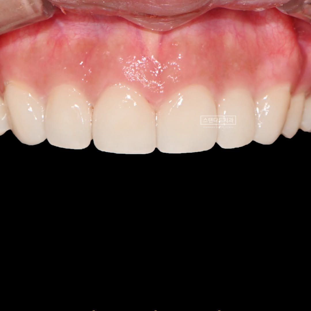 Photo shared by 스탠다드치과 심미치료 on January 09, 2025 tagging @standard__dental, @std2000dental, and @standard__bucheon.