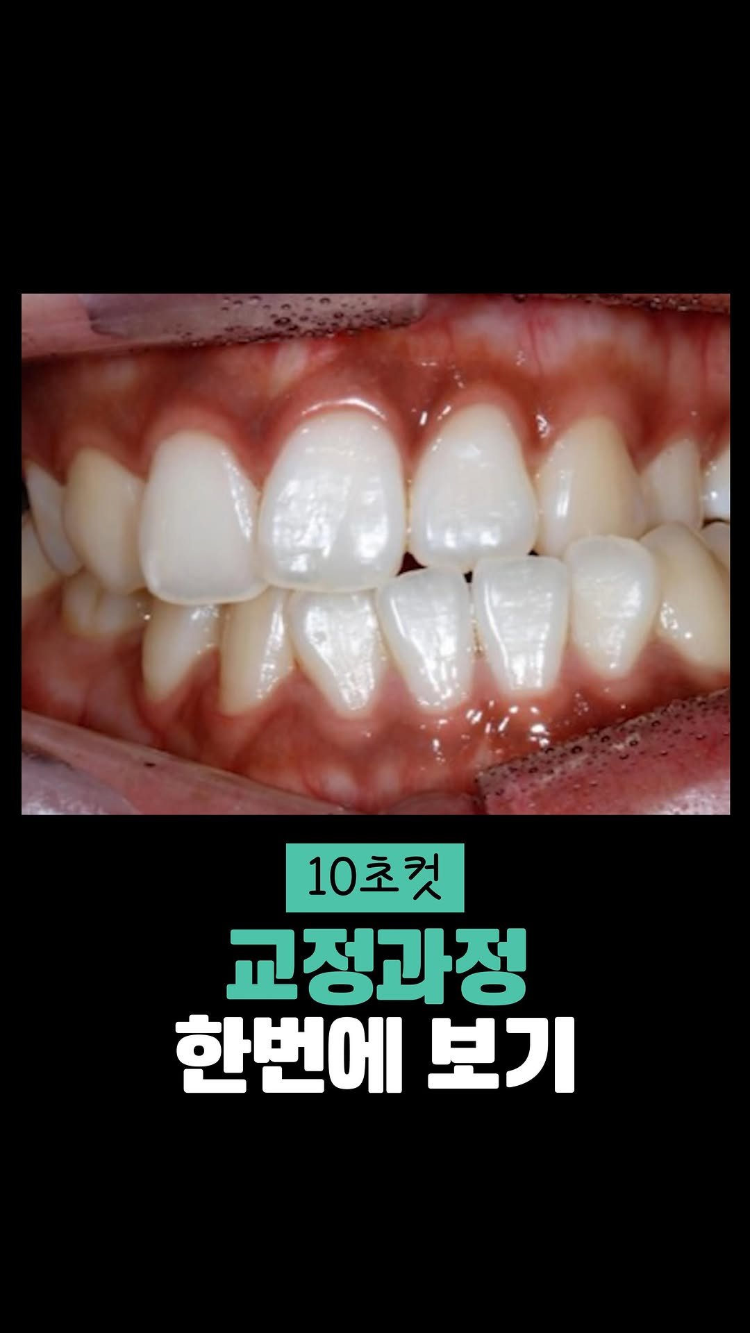 smile_by_standard 게시물 이미지: 10초로 확인하는 교정과정

✔️틀어져있던 정중선이 제자리를 찾아가는 과정...