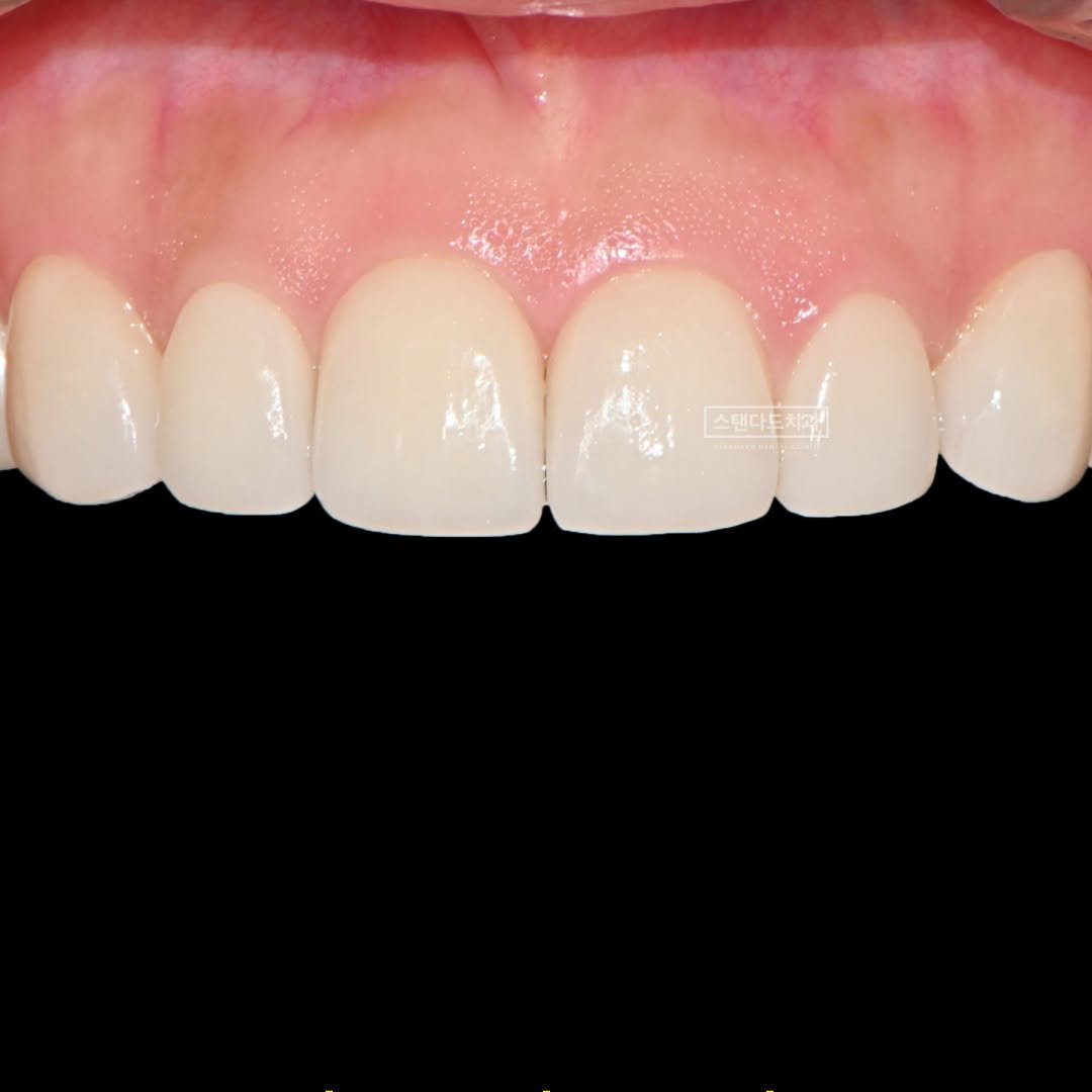 Photo by 스탠다드치과 | 바이오닉라미네이트 | 치아미백 | 잇몸성형 on January 09, 2025.