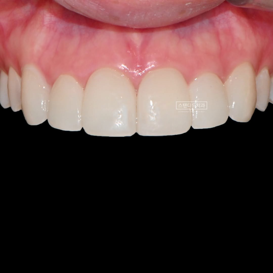 Photo by 스탠다드치과 심미치료 on January 09, 2025.