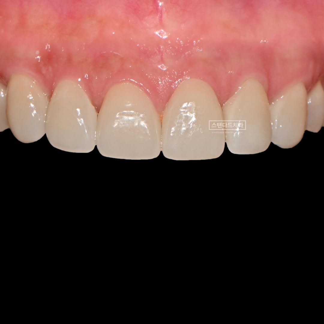 Photo by 스탠다드치과 심미치료 on February 04, 2025.