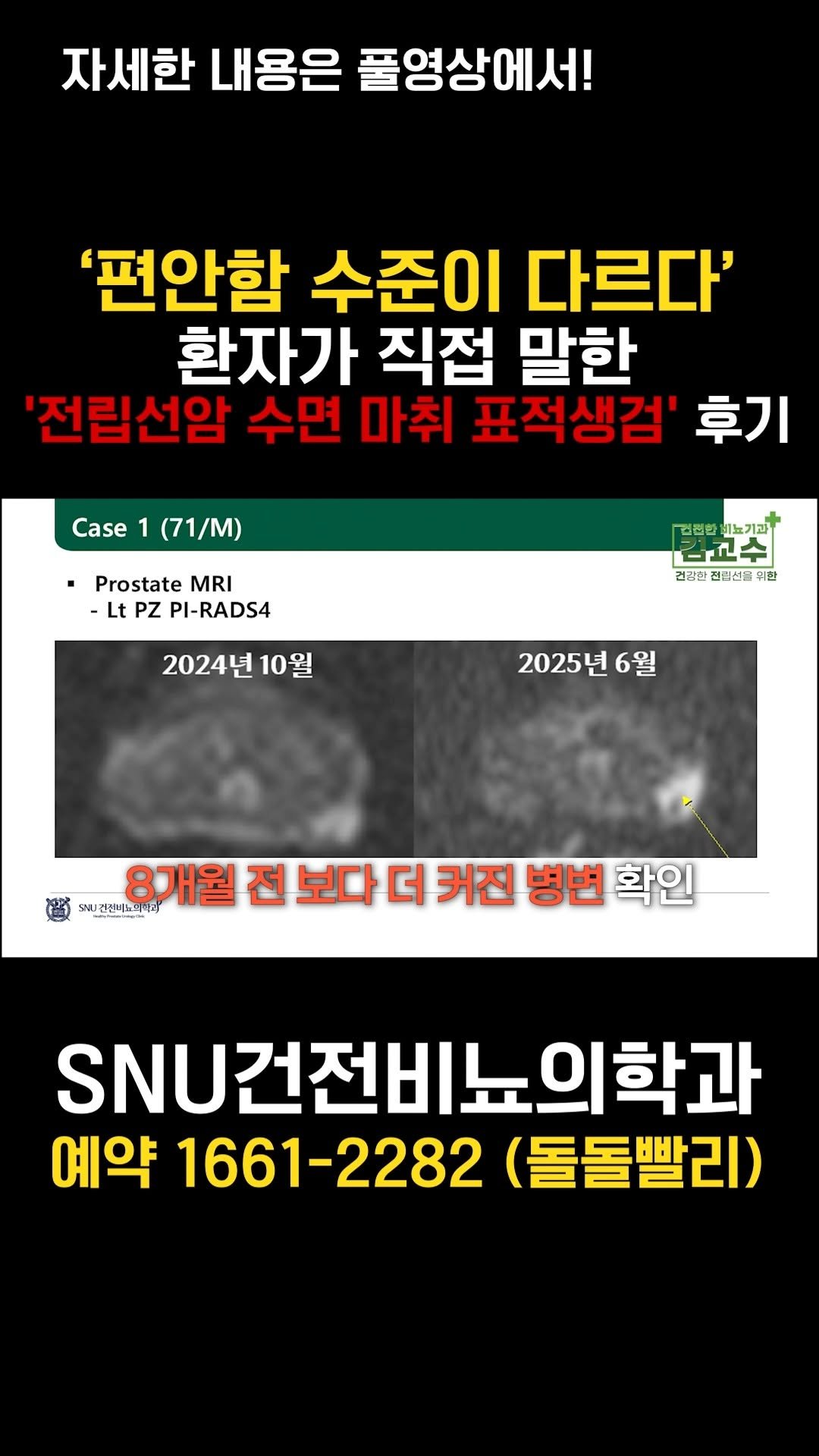 snu_urology 게시물 이미지: ‘편안함 수준이 다르다’ 환자가 직접 말한 '전립선암 수면 마취 표적생검' 후기...
