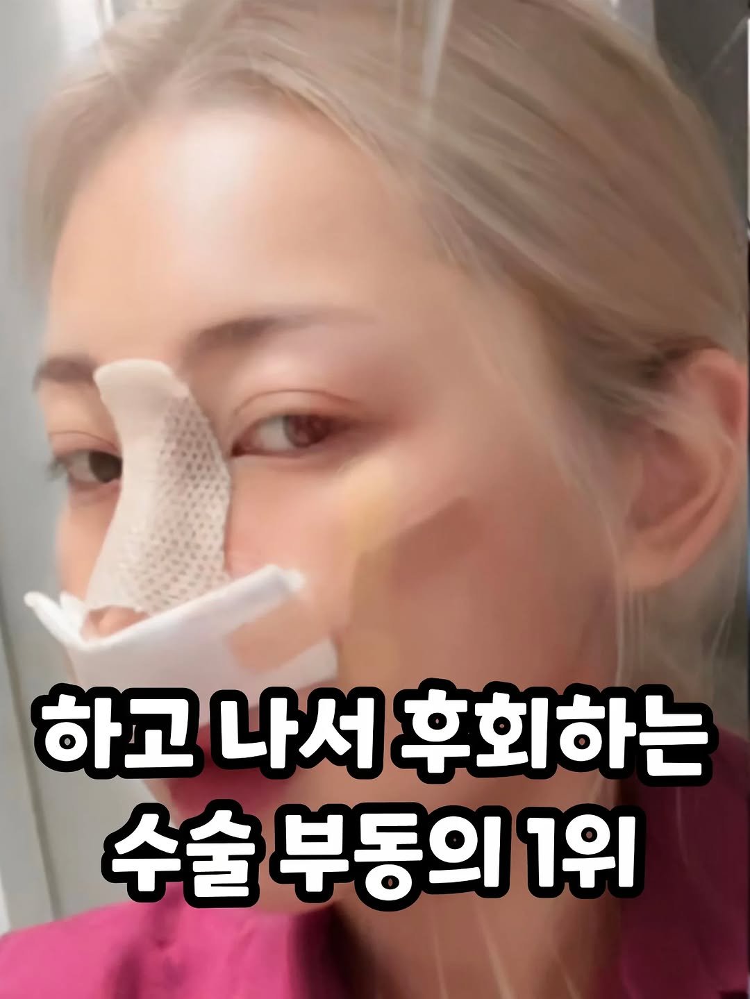 some2lve 게시물 이미지: 경험자 대다수가 후회한다는 수술..
