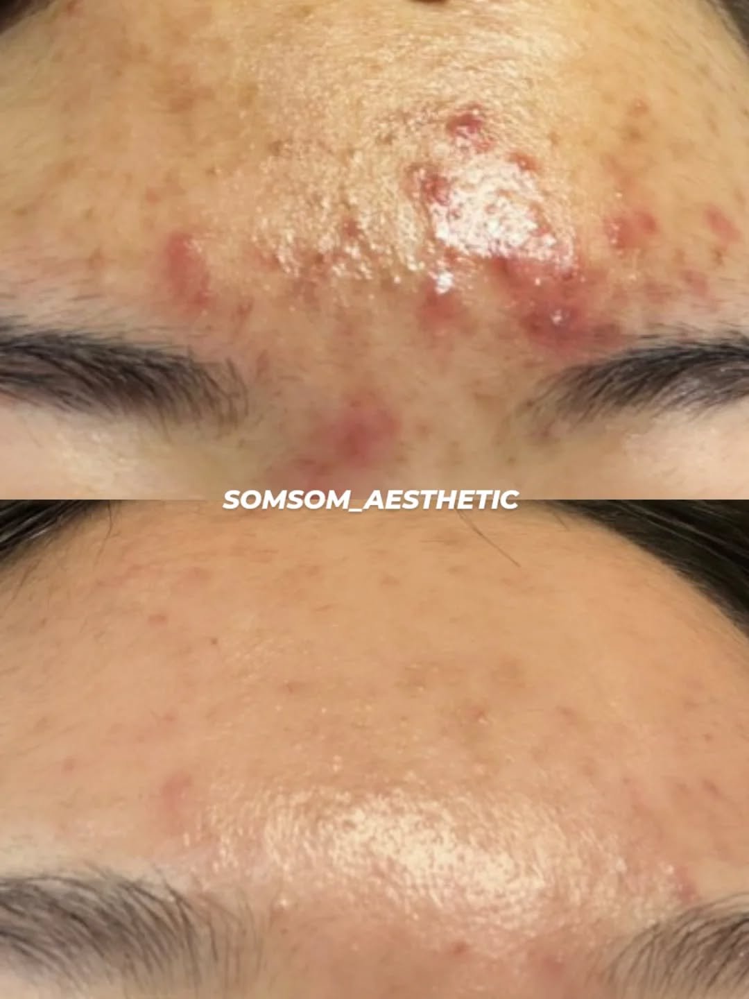 somsom_aesthetic 게시물 이미지: 여드름인 줄 알고 짰는데 더 번지는 피부, 
압출을 받아도 그때뿐인 염증. 혹시...