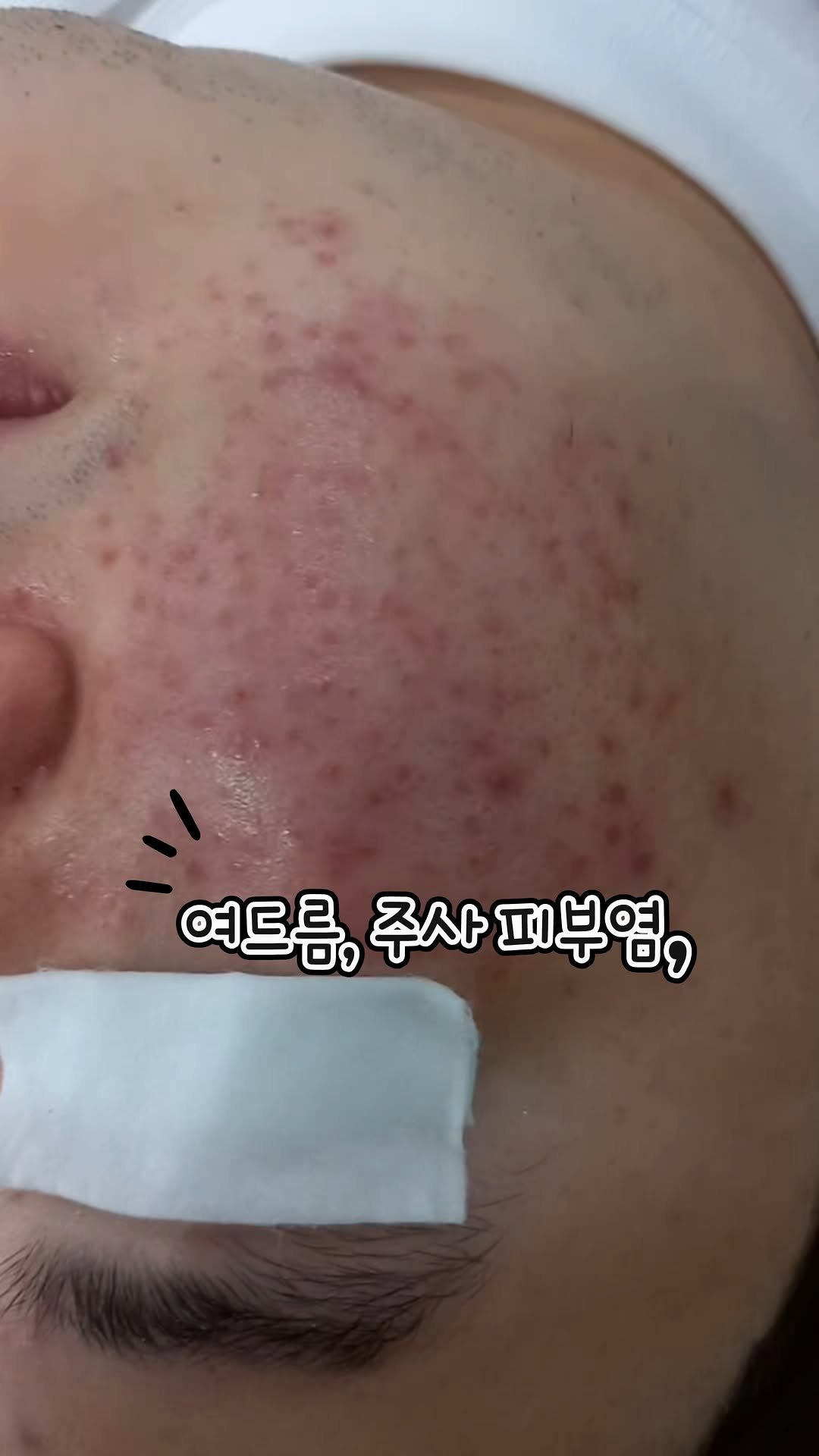 somsom_aesthetic 게시물 이미지: 여드름, 주사피부염, 지루성 피부염은 
단순히 가린다고 해결되지 않습니다....