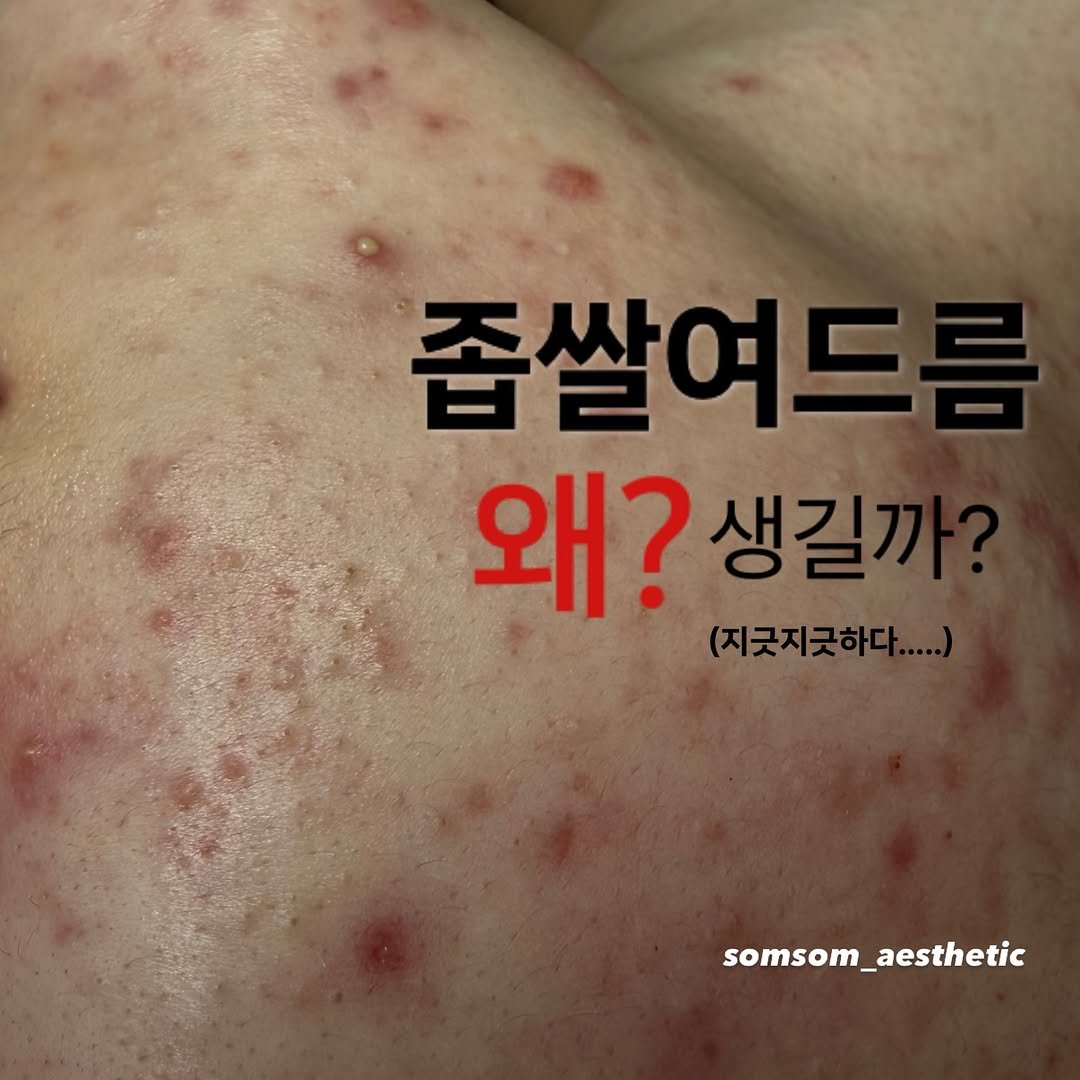somsom_aesthetic 게시물 이미지: 조명 아래서 더 도드라져 보이는 요철들..
화장으로 가리려다 오히려 더 부각돼서...