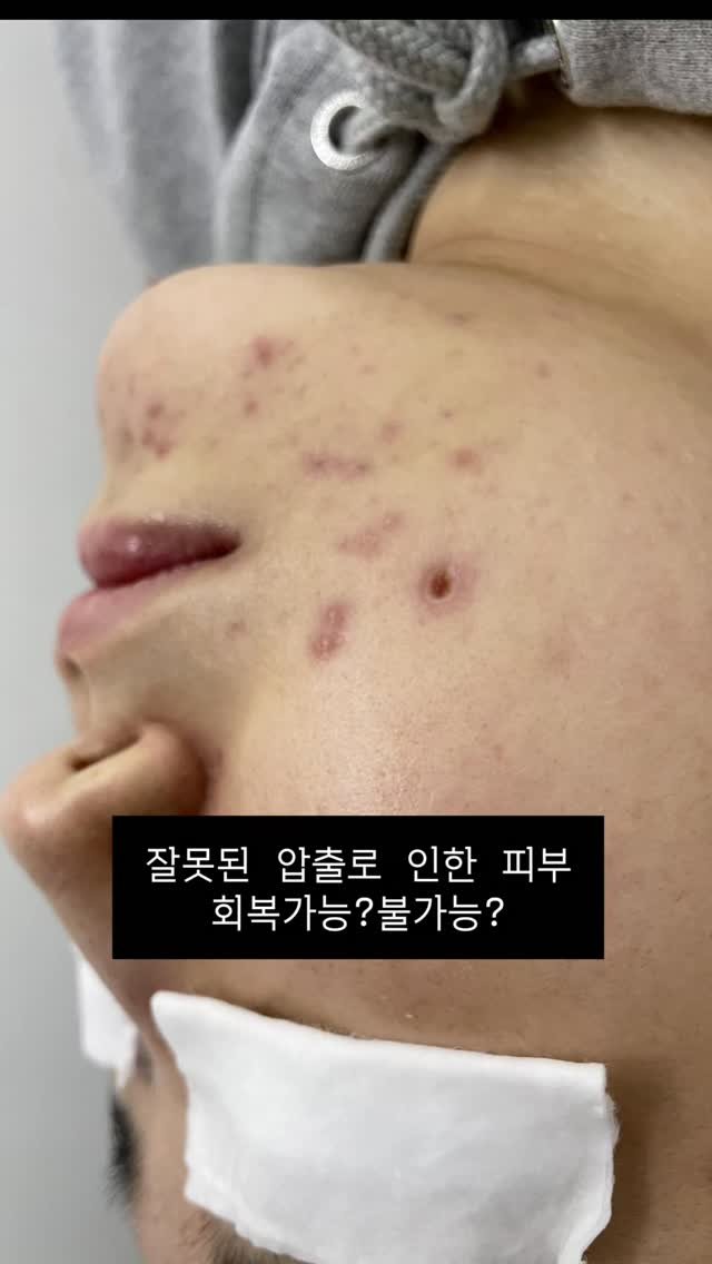 somsom_aesthetic 게시물 이미지: 잘못된 여드름 압출 및 기기사용으로 인한.. 피해사례..

지금이야 너무 잘 회복...