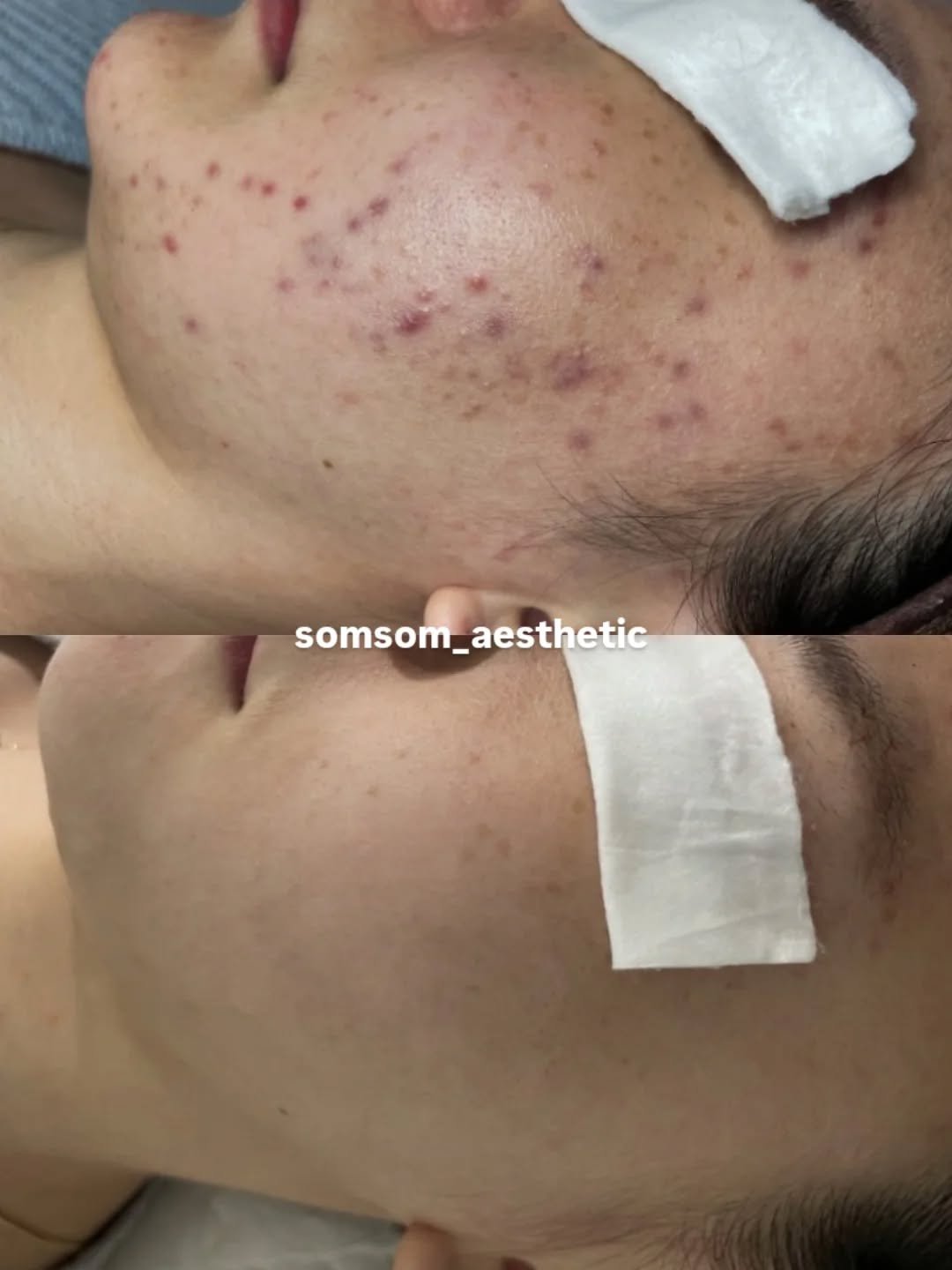 somsom_aesthetic 게시물 이미지: "오늘의 압출이 내일의 흉터를 결정합니다"

여드름, 무작정 짜지 마세요.
제대로...