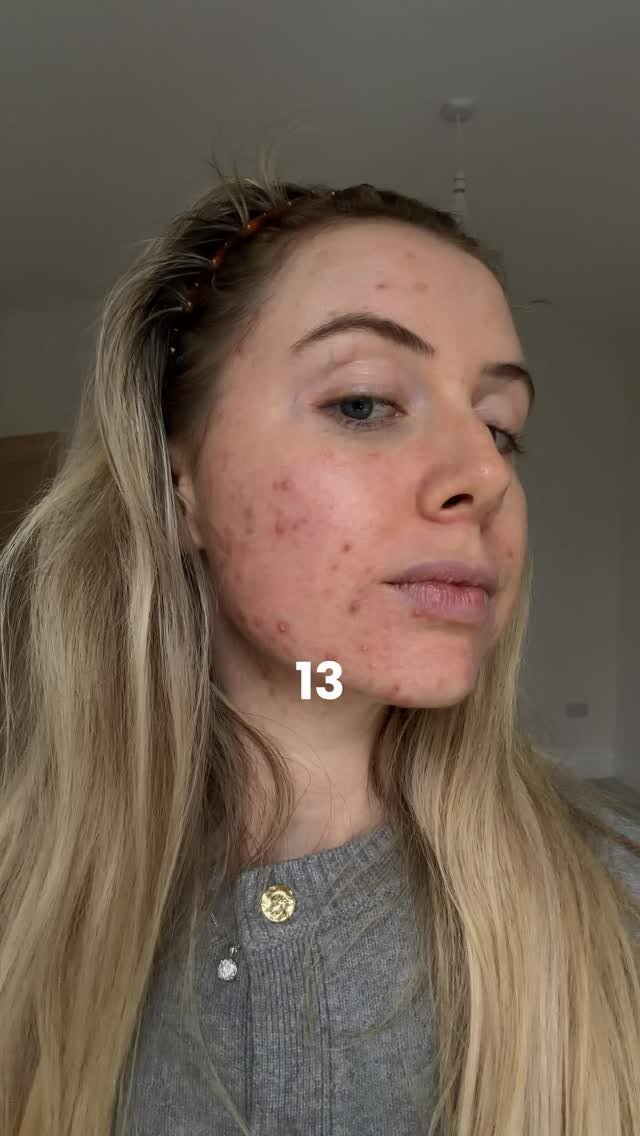sophie.richards 게시물 이미지: 13 years of battling my skin and I’m STILL...