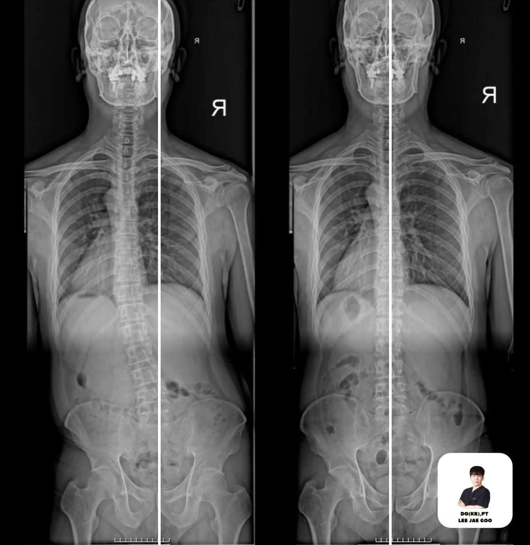 spine_bone_ 게시물 이미지: 11회 재활운동을 진행하고 재촬영하였습니다🫠

Thoacic mobilization...