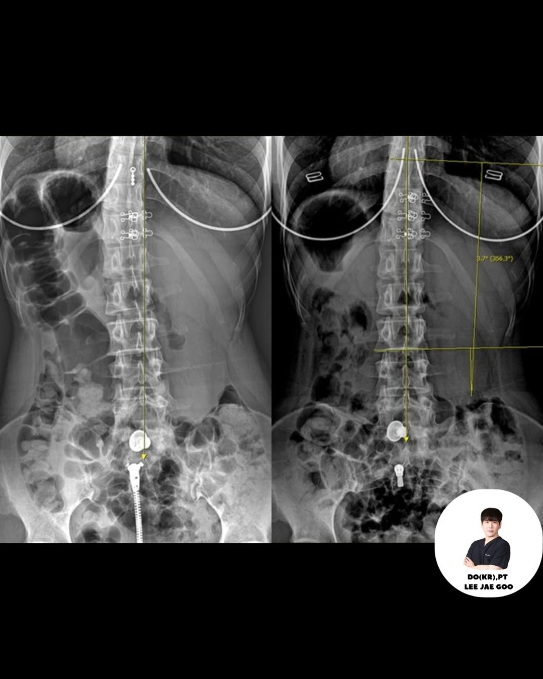 spine_bone_ 게시물 이미지: 요추 측만증, 10회 재활 결과입니다.

Lumbar의 centration,...