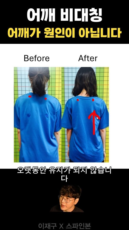 spine_bone_ 게시물 이미지: 👇 댓글에 '임상운동학' = 무료강의 링크 DM으로 보내드려요

어깨 비대칭,...