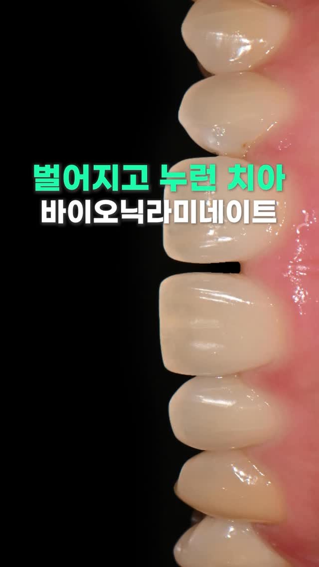 standard__dental 게시물 이미지: 벌어진 치아도 바이오닉 라미네이트,
웃을 때마다 신경쓰였는데 이젠 웃는 모습이...