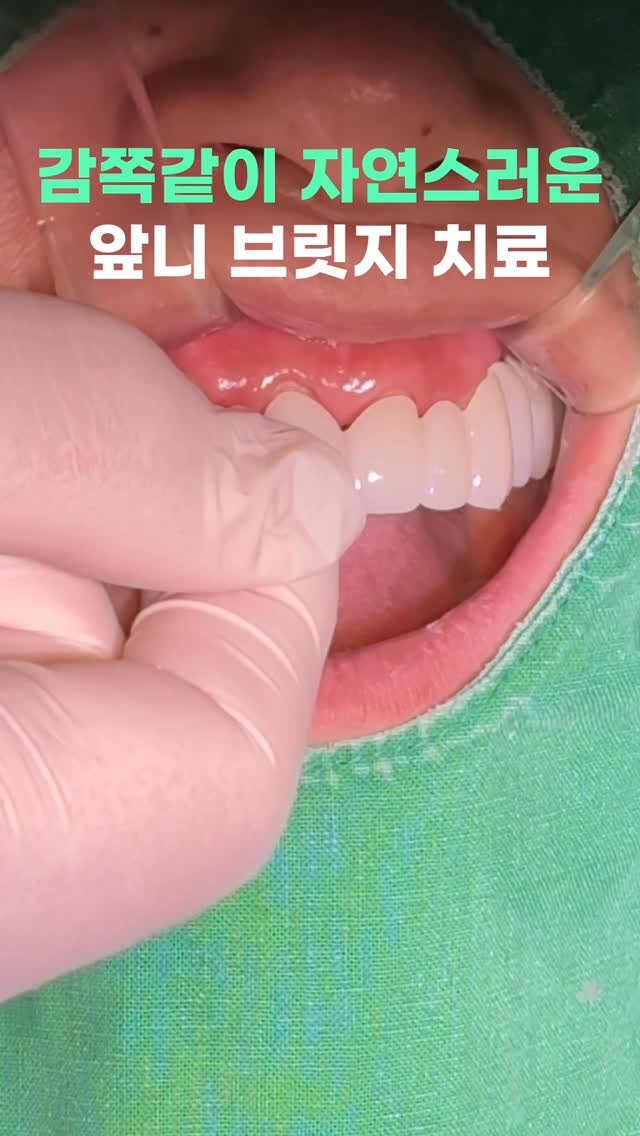 standard__dental 게시물 이미지: 감쪽같은 앞니 브릿지 크라운🦷
#치과 #잠실치과 #앞니