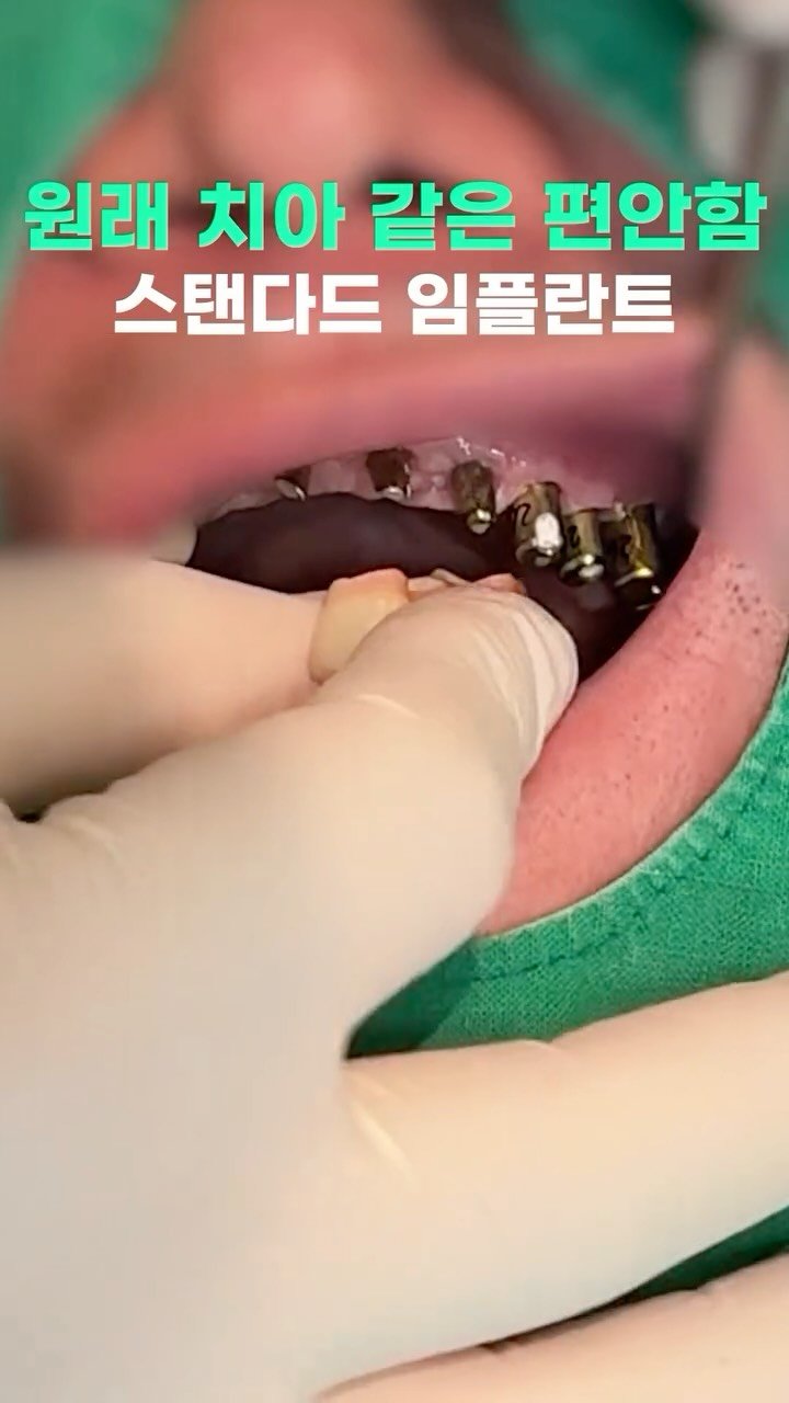standard__dental 게시물 이미지: 원래 치아 같은 편안함,
얼굴형까지 생각하는 스탠다드 임플란트☺️
#임플란트 #잠실 #치과