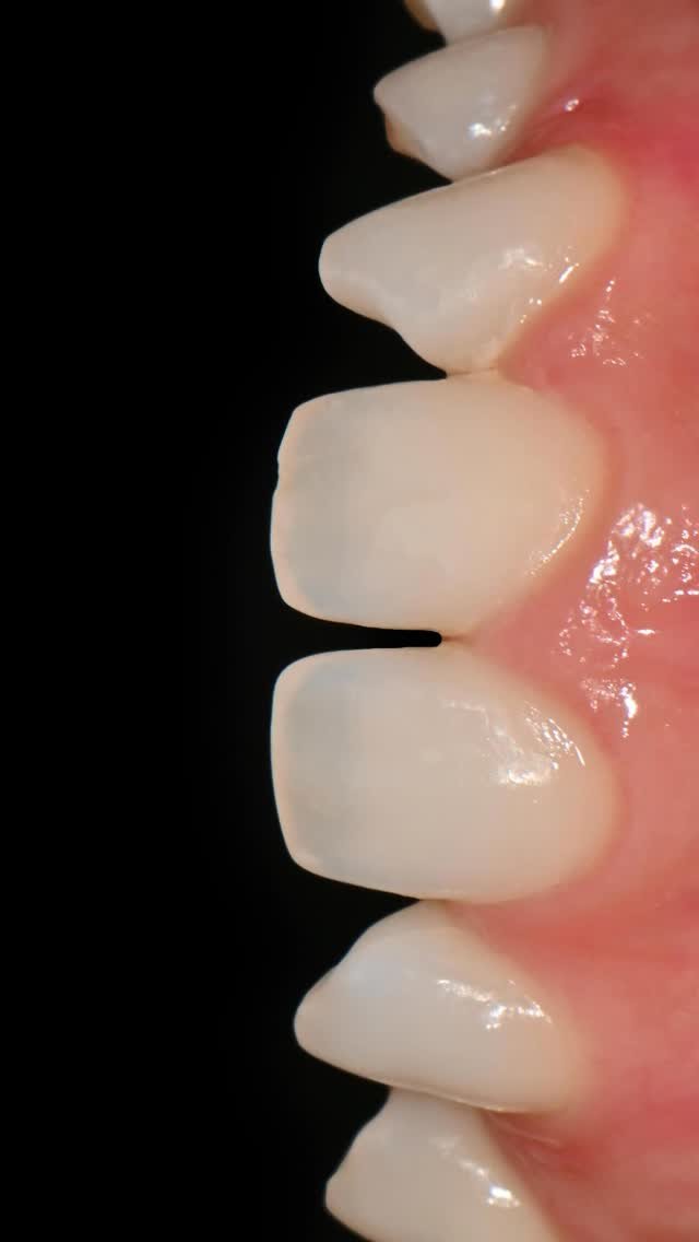 standard__dental 게시물 이미지: 💬뾰족뾰족한 치아가 마음에 들지 않아요
💬치아 사이 공간이 채워졌으면...